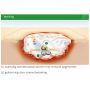 Suprasorb A tampon 30cm 2g